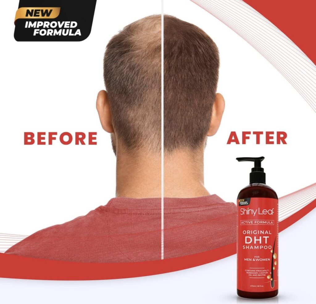 Fighting Hair Loss and Low Testosterone Naturally